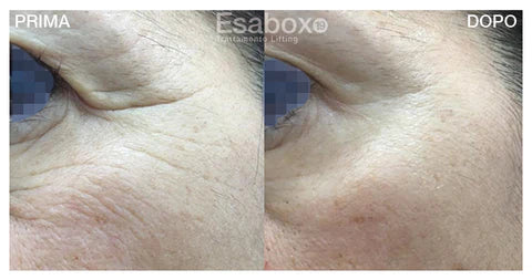 BOTOX a casa "Botulino-Like" Kit Personal Lifting in 2 Fasi